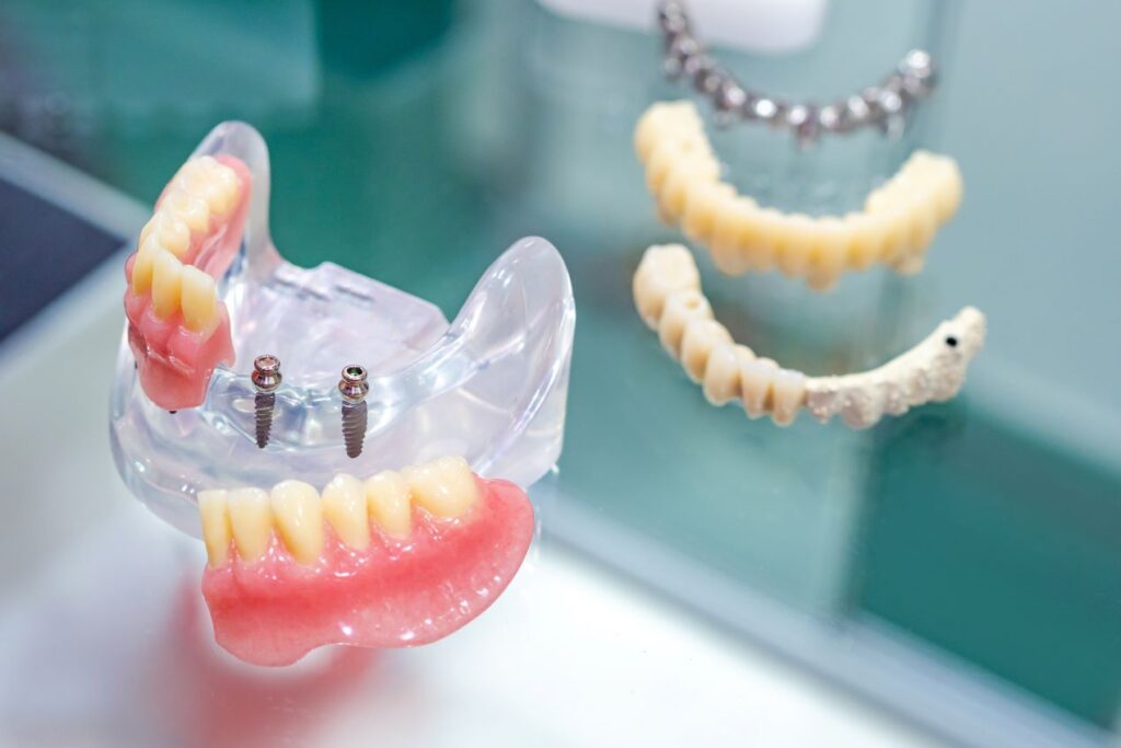 Verschiedene Zahnprothesen und Implantatmodelle, die in der Implantologie Essen verwendet werden